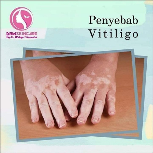  PENYEBAB VITILIGO  DRW SKINCARE ARTIKEL Pusat Perawatan 