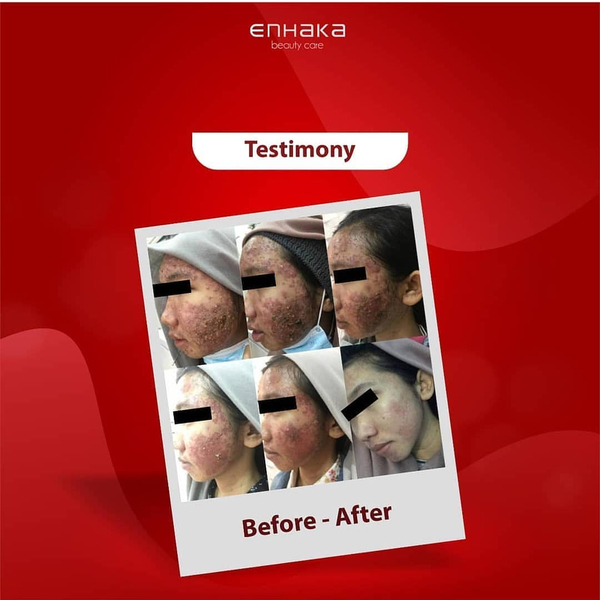 Testimony intensive acne treatment 