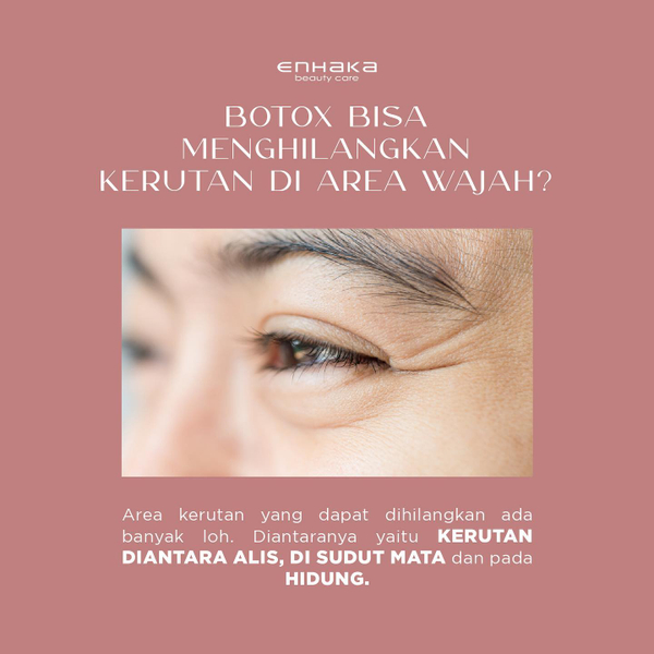 Botox bisa Menghilangkan Kerutan Di Area Wajah 