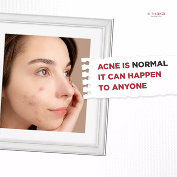 ACNE IS NORMAL IT CAN HAPPEN TO ANYONE